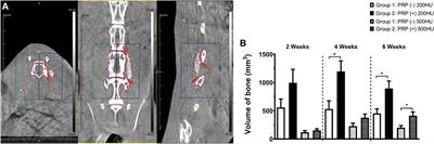 Improved Posterolateral Lumbar Spinal Fusion Using a Biomimetic, Nanocomposite Scaffold Augmented by Autologous Platelet-Rich Plasma